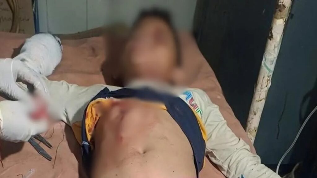 Three teenagers sustained burn injuries in gunpowder explosion